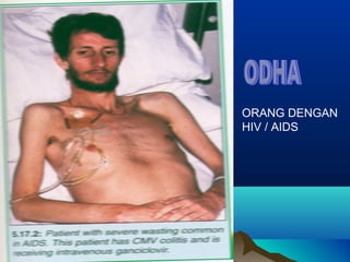 ORANG DENGAN
HIV / AIDS
 