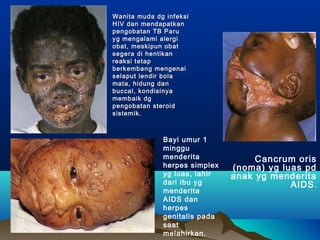 Wanita muda dg infeksiWanita muda dg infeksi
HIV dan mendapatkanHIV dan mendapatkan
pengobatan TB Parupengobatan TB Paru
yg mengalami alergiyg mengalami alergi
obat, meskipun obatobat, meskipun obat
segera di hentikansegera di hentikan
reaksi tetapreaksi tetap
berkembang mengenaiberkembang mengenai
selaput lendir bolaselaput lendir bola
mata, hidung danmata, hidung dan
buccal, kondisinyabuccal, kondisinya
membaik dgmembaik dg
pengobatan steroidpengobatan steroid
sistemik.sistemik.
Cancrum oris
(noma) yg luas pd
anak yg menderita
AIDS.
Bayi umur 1
minggu
menderita
herpes simplex
yg luas, lahir
dari ibu yg
menderita
AIDS dan
herpes
genitalis pada
saat
melahirkan.
 