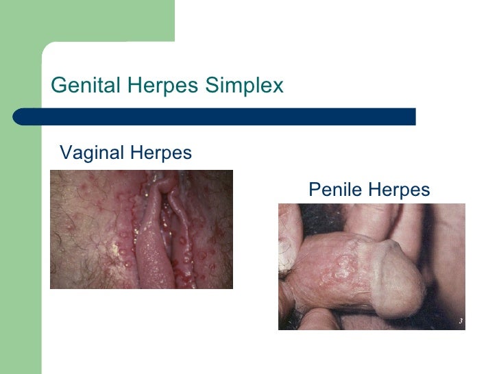 What Does Herpes Look Like - Pictures of STDs - The STD ...