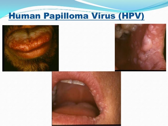 test oral hpv Control HIV Prevention & AIDS test oral hpv Control HIV Prevention & AIDS
