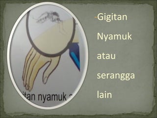 -Gigitan
Nyamuk
atau
serangga
lain
 