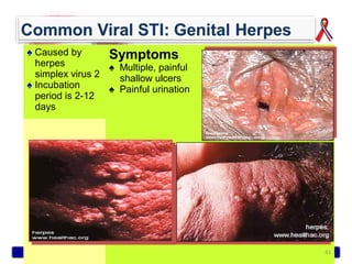 ♠ Caused by       Symptoms
  herpes          ♠ Multiple, painful
  simplex virus 2   shallow ulcers
♠ Incubation      ♠ Painful urination
  period is 2-12
  days




                     Philippine National AIDS Council   41
 