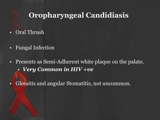 Oropharyngeal Candidiasis
• Oral Thrush
• Fungal Infection
• Presents as Semi-Adherent white plaque on the palate.
• Very Common in HIV +ve
• Glossitis and angular Stomatitis, not uncommon.

 