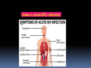 Stage 1- Acute HIV infection
 