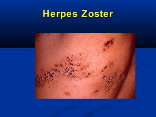 Herpes Zoster

 