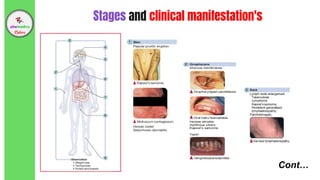 Cont…
Stages and clinical manifestation's
 