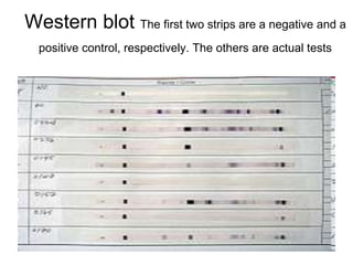 Western blot The first two strips are a negative and a
positive control, respectively. The others are actual tests
 