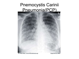 Pnemocystis Carinii
Pneumonia(PCP)
 