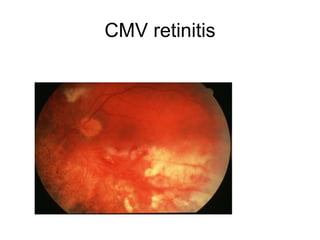 CMV retinitis
 
