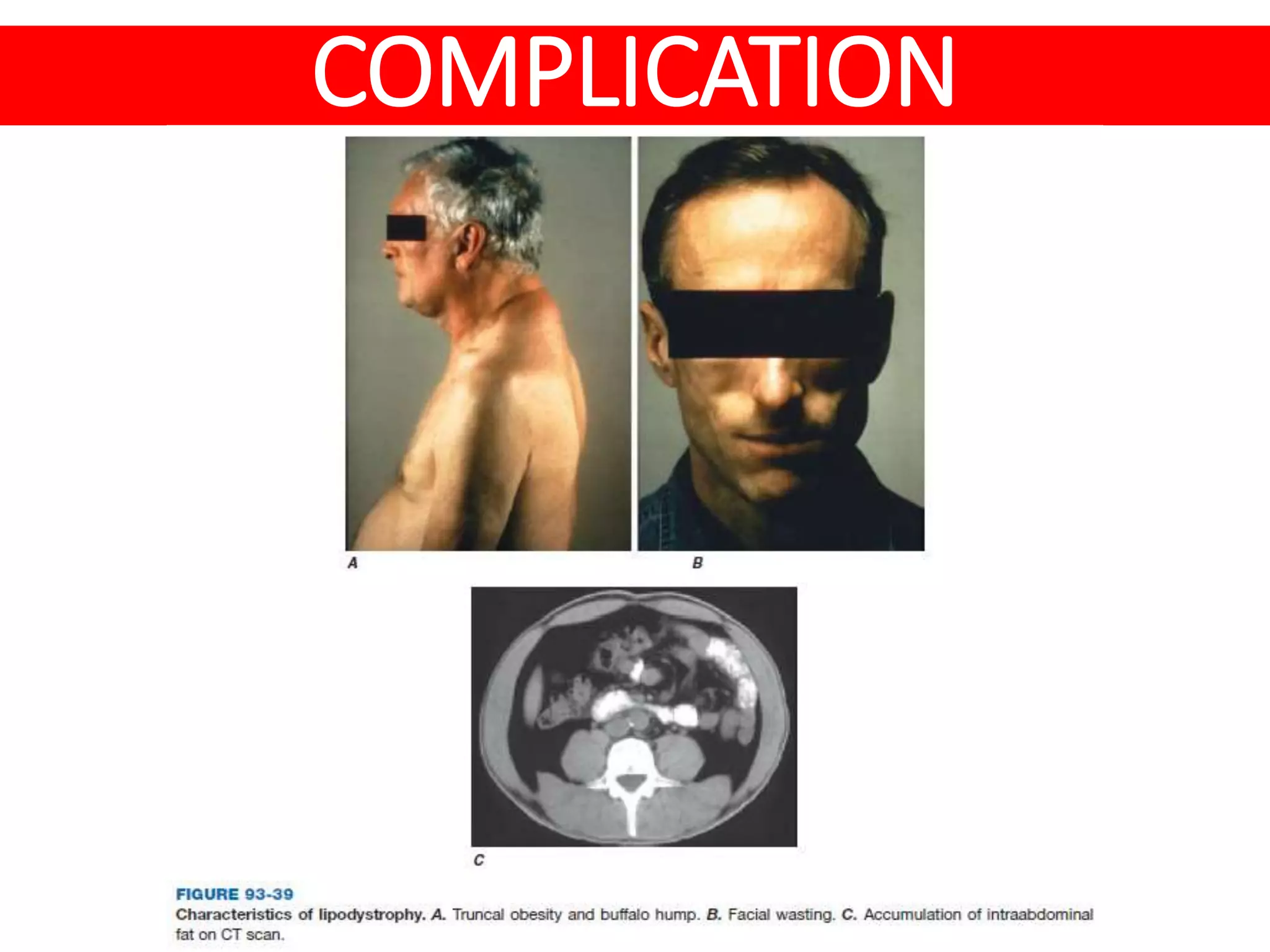 HIV AIDS - Risk factor, Clinical feature & Complication | PPTX