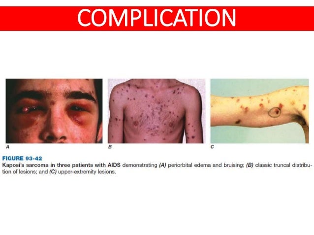 HIV AIDS - Risk factor, Clinical feature & Complication