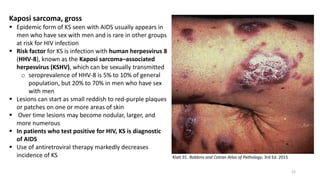 Kaposi sarcoma, gross
 Epidemic form of KS seen with AIDS usually appears in
men who have sex with men and is rare in oth...
