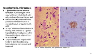 Klatt EC. Robbins and Cotran Atlas of Pathology, 3rd Ed. 2015
Toxoplasmosis, microscopic
 T. gondii infection can result ...