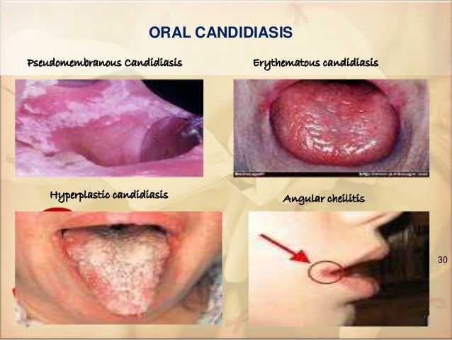Nhs Candida Blood Test Candida Diet Blue Cheese