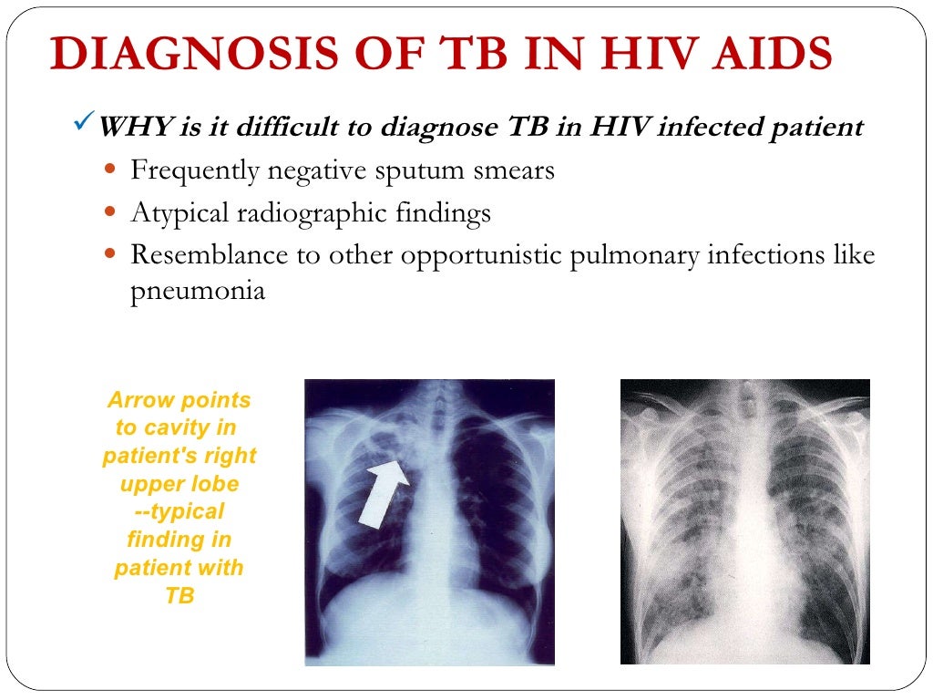 hesi pn case study hiv and tuberculosis