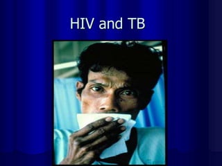 HIV and TB
 