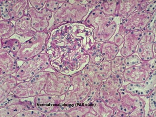 Normal renal biopsy (PAS stain)
