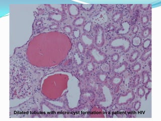 Dilated tubules with micro-cyst formation in a patient with HIV
