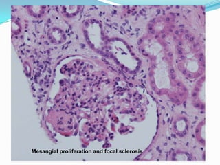 Mesangial proliferation and focal sclerosis