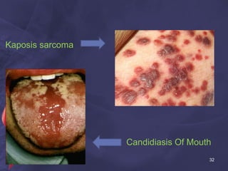 Kaposis sarcoma
Candidiasis Of Mouth
32
 