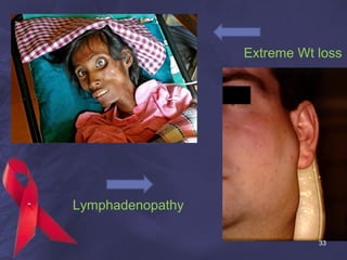 Extreme Wt loss
Lymphadenopathy
33
 