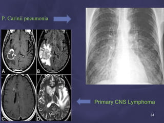 P. Carinii pneumonia
Primary CNS Lymphoma
34
 