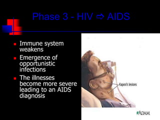 Phase 3 - HIV  AIDS
 Immune system
weakens
 Emergence of
opportunistic
infections
 The illnesses
become more severe
leading to an AIDS
diagnosis
 