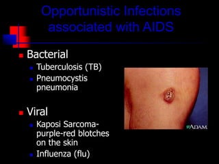 Opportunistic Infections
associated with AIDS
 Bacterial
 Tuberculosis (TB)
 Pneumocystis
pneumonia
 Viral
 Kaposi Sarcoma-
purple-red blotches
on the skin
 Influenza (flu)
 