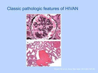 Classic pathologic features of HIVAN
Wyatt CM et al. Annu Rev Med. 2012;63:147-59.
 