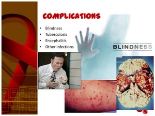COMPLICATIONS
•   Blindness
•   Tuberculosis
•   Encephalitis
•   Other infections
 