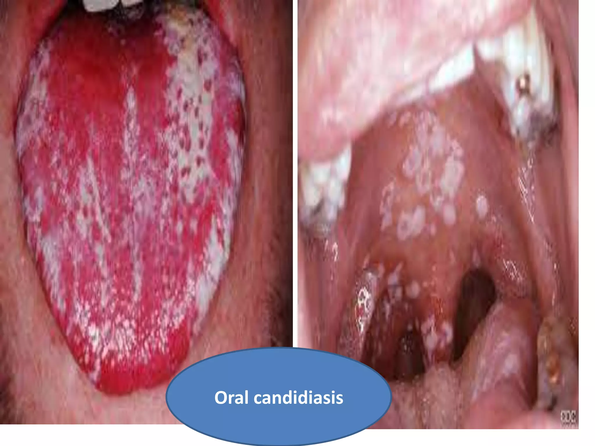 Oral candidiasis
 