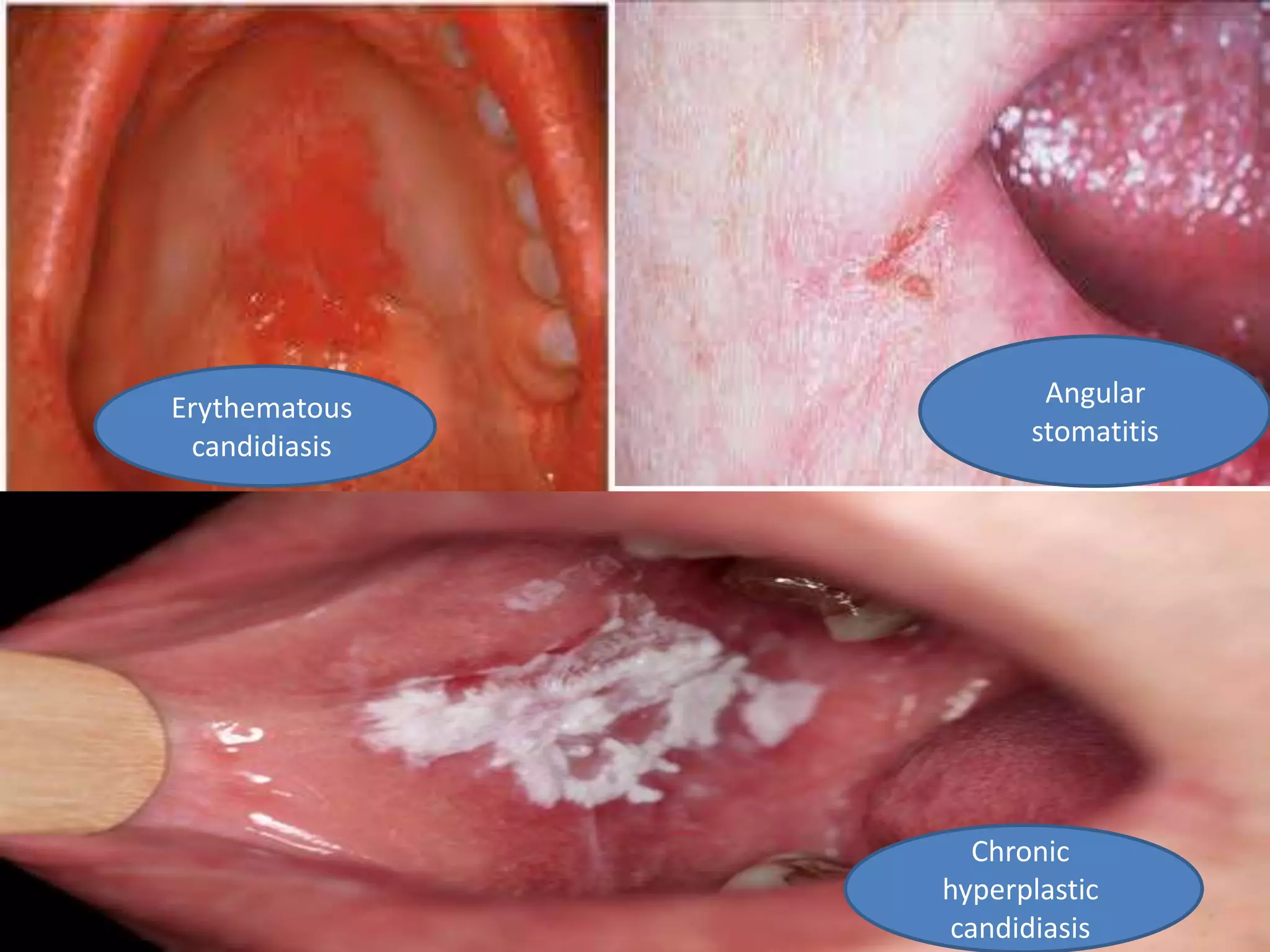 Erythematous
candidiasis
Angular
stomatitis
Chronic
hyperplastic
candidiasis
 