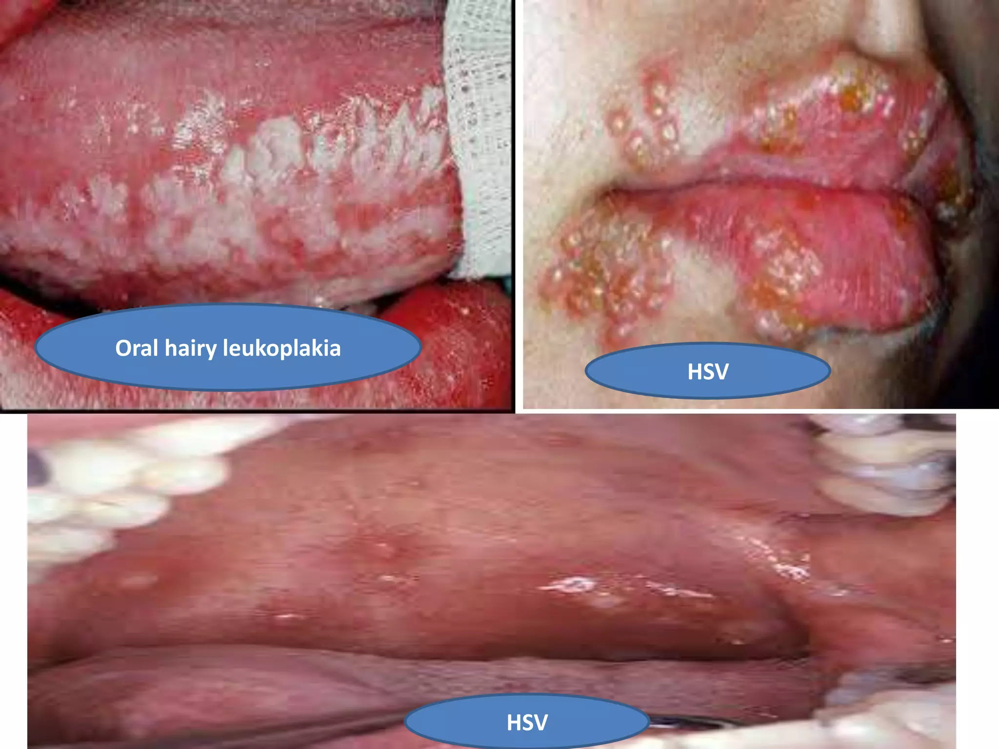 Oral hairy leukoplakia
HSV
HSV
 