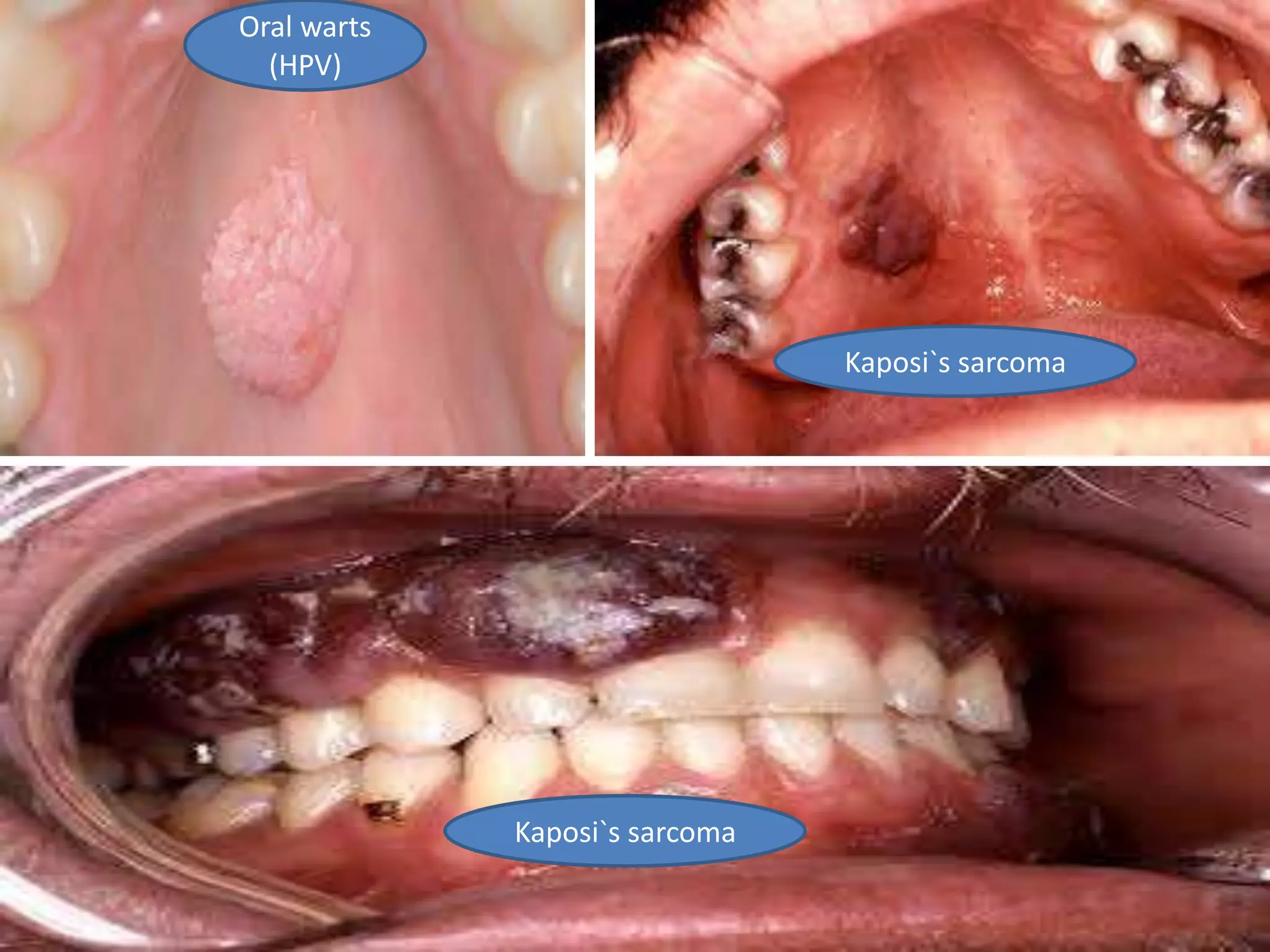 Oral warts
(HPV)
Kaposi`s sarcoma
Kaposi`s sarcoma
 