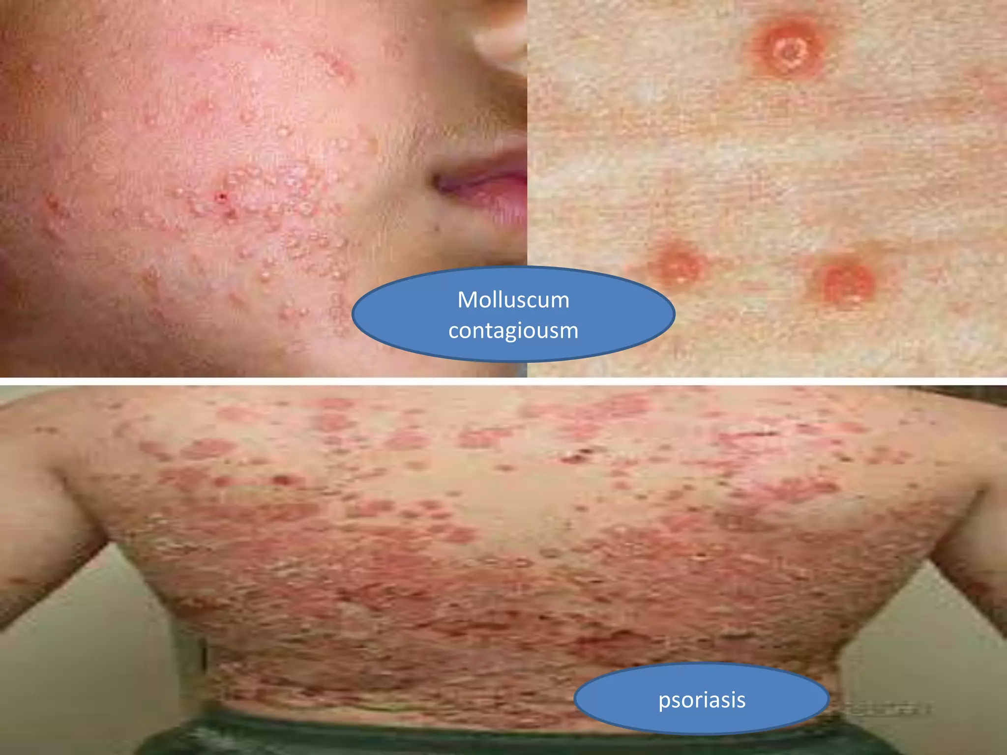 Molluscum
contagiousm
psoriasis
 