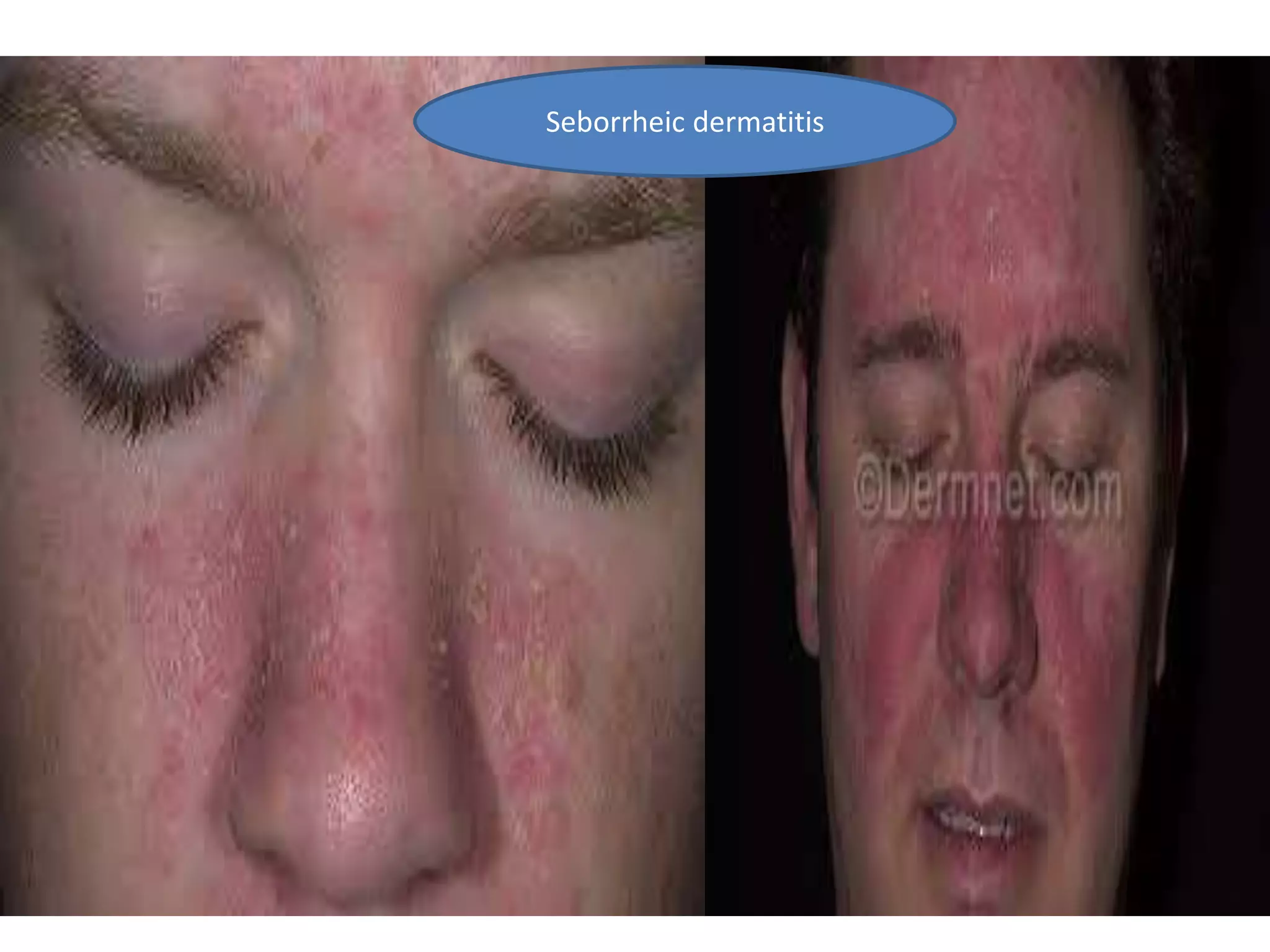 Seborrheic dermatitis
 