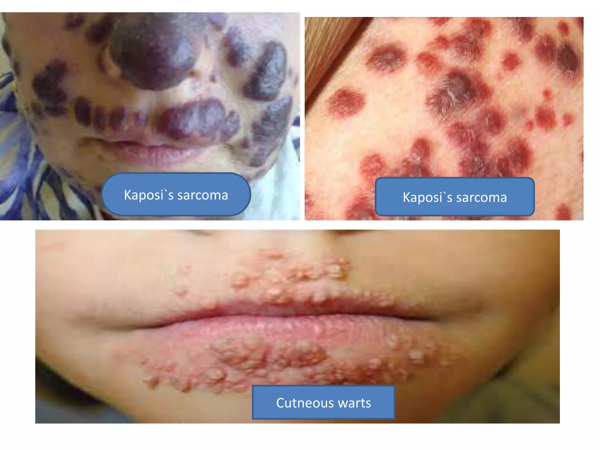 Kaposi`s sarcomaKaposi`s sarcoma
Cutneous warts
 