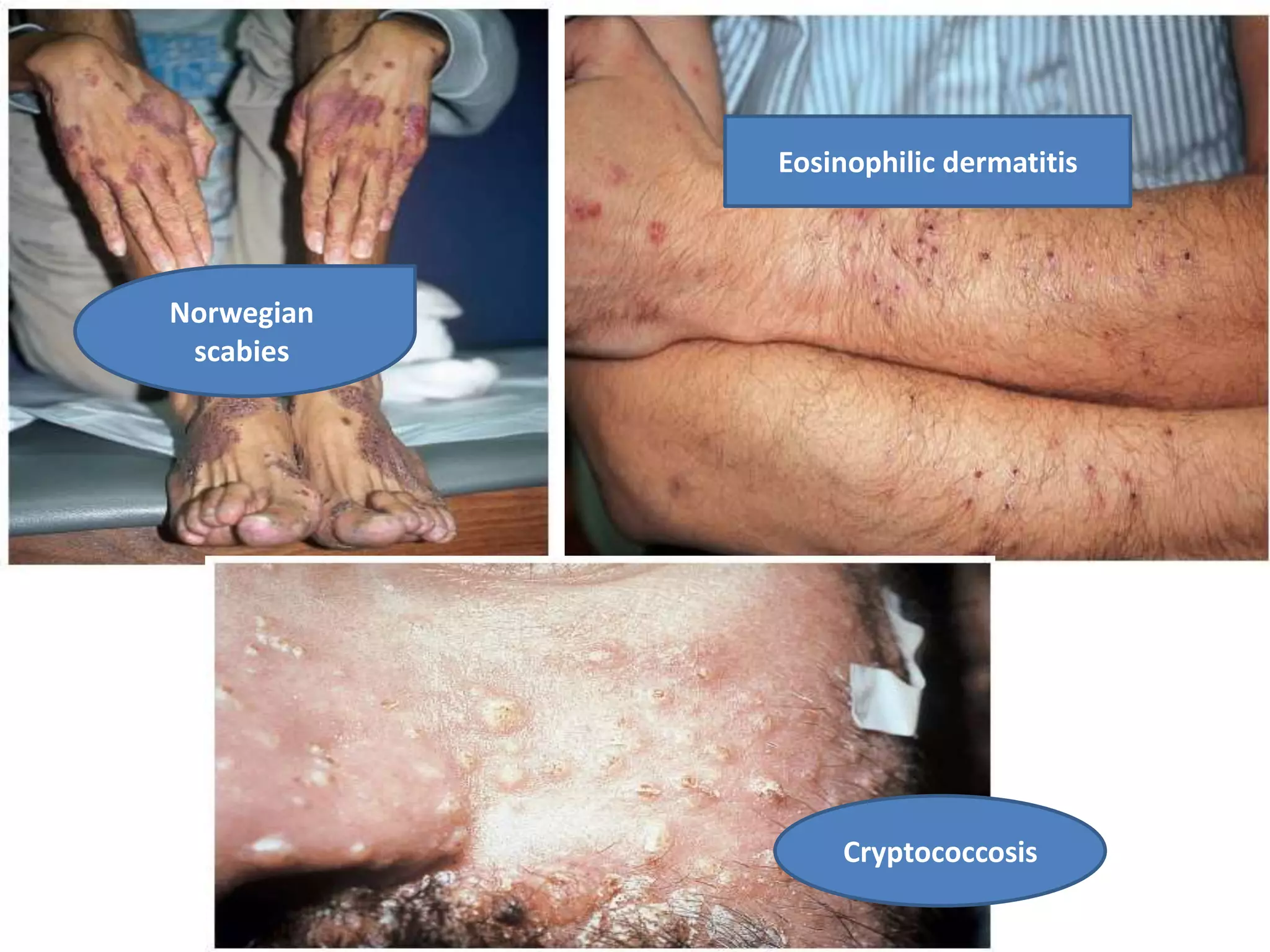 Eosinophilic dermatitis
Norwegian
scabies
Cryptococcosis
 