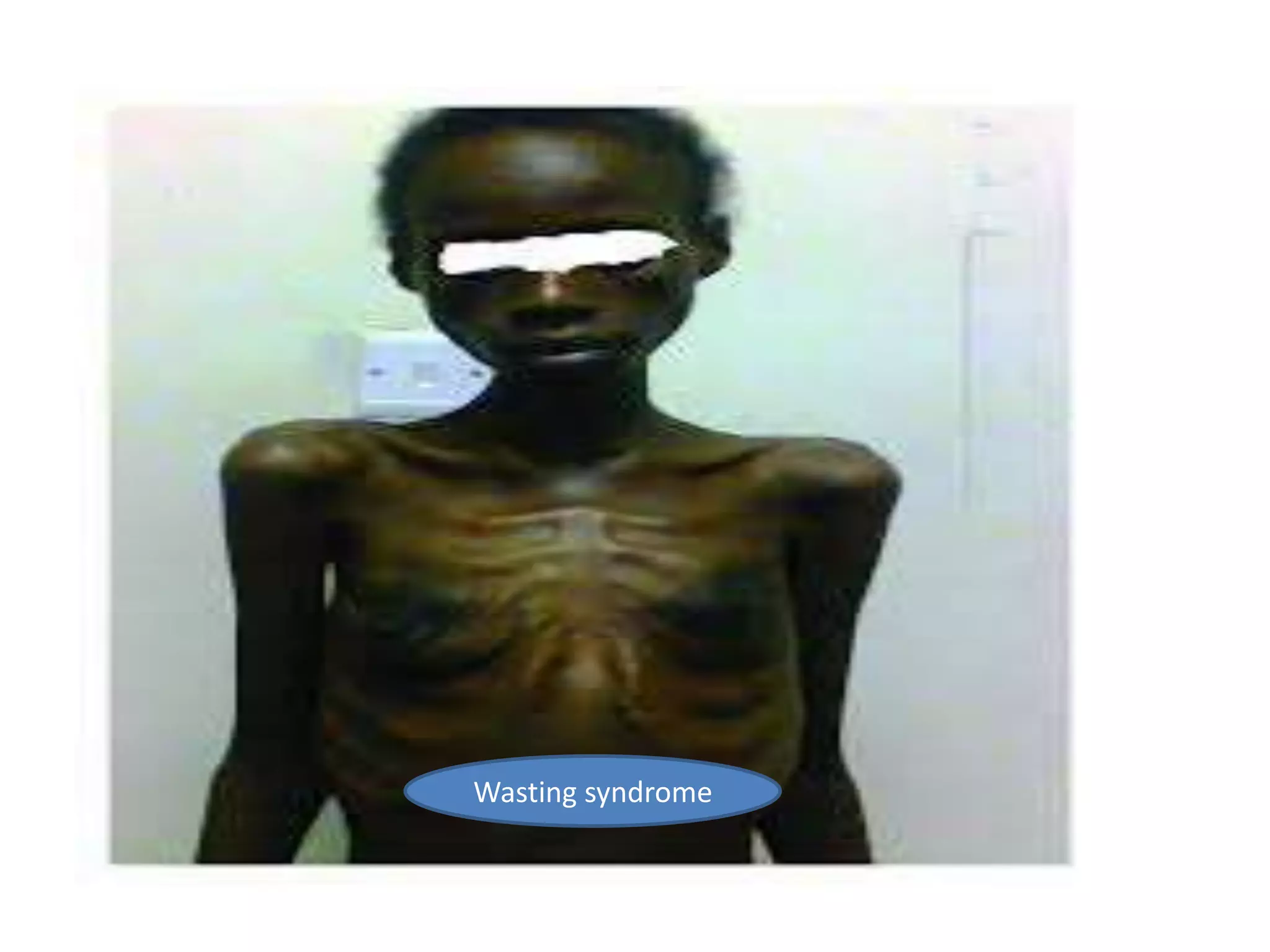 Wasting syndrome
 