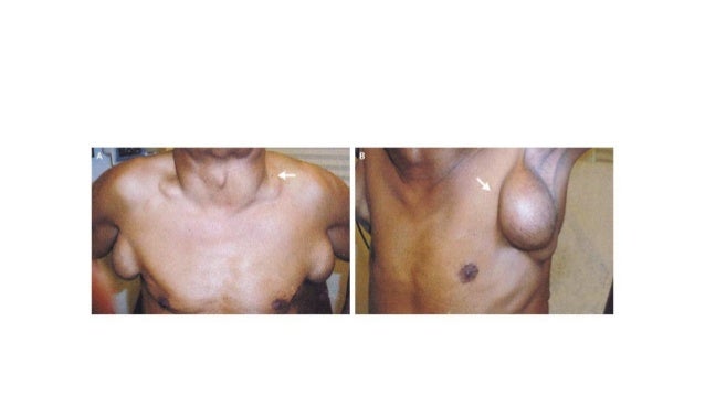 swollen lymph nodes hiv