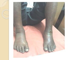 Hiv & leprosy FRIEND OR FOE