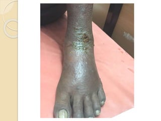 Hiv & leprosy FRIEND OR FOE