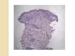 Hiv & leprosy FRIEND OR FOE