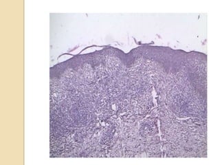 Hiv & leprosy FRIEND OR FOE