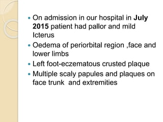  On admission in our hospital in July
2015 patient had pallor and mild
Icterus
 Oedema of periorbital region ,face and
lower limbs
 Left foot-eczematous crusted plaque
 Multiple scaly papules and plaques on
face trunk and extremities
 