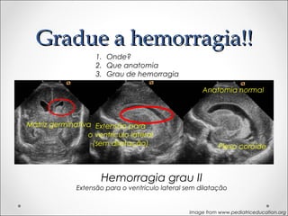GGrraadduuee aa hheemmoorrrraaggiiaa!!!! 
1. Onde? 
2. Que anatomia 
3. Grau de hemorragia 
Matriz germinativa Extensão para 
o ventrículo lateral 
(sem dilatação) 
Anatomia normal 
Plexo coróide 
Hemorragia grau II 
Extensão para o ventriculo lateral sem dilatação 
Image from www.pediatriceducation.org 
 