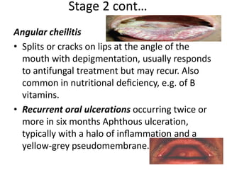Stage 2 cont… 
Angular cheilitis 
• Splits or cracks on lips at the angle of the 
mouth with depigmentation, usually responds 
to antifungal treatment but may recur. Also 
common in nutritional deficiency, e.g. of B 
vitamins. 
• Recurrent oral ulcerations occurring twice or 
more in six months Aphthous ulceration, 
typically with a halo of inflammation and a 
yellow-grey pseudomembrane. 
 