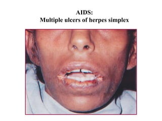 AIDS:
Multiple ulcers of herpes simplex
 