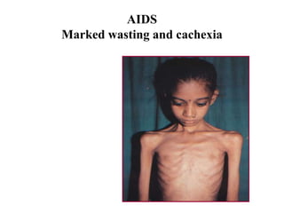 AIDS
Marked wasting and cachexia
 