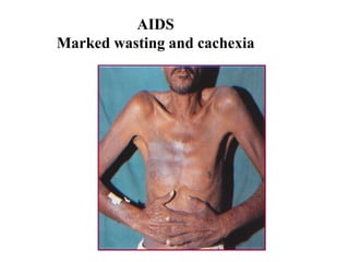 AIDS
Marked wasting and cachexia
 